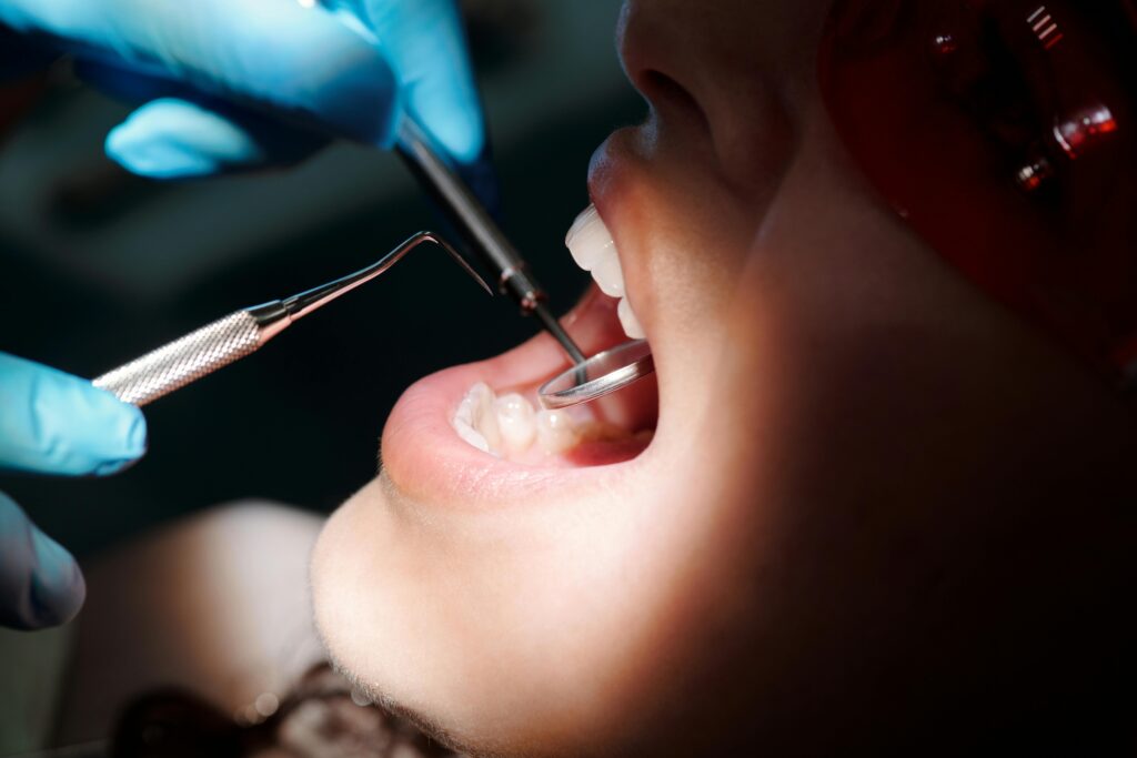 Qué es la placa bacteriana y cómo afecta los dientes