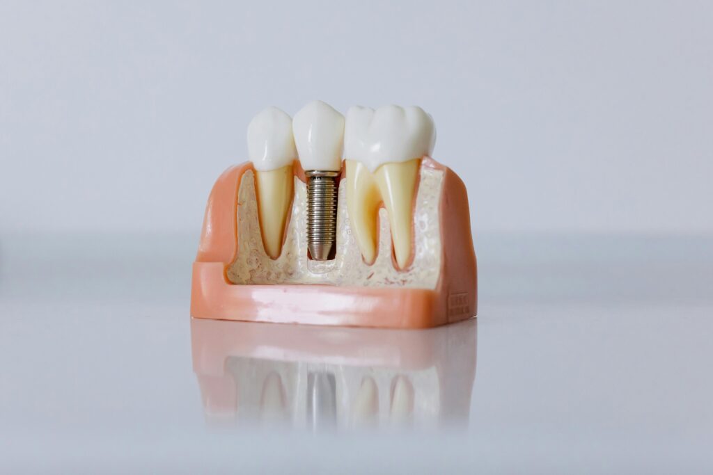 Implantes dentales: una solución moderna para reemplazar dientes perdidos