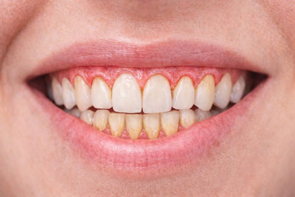 Encías retraídas: causas, síntomas y tratamiento de la recesión gingival